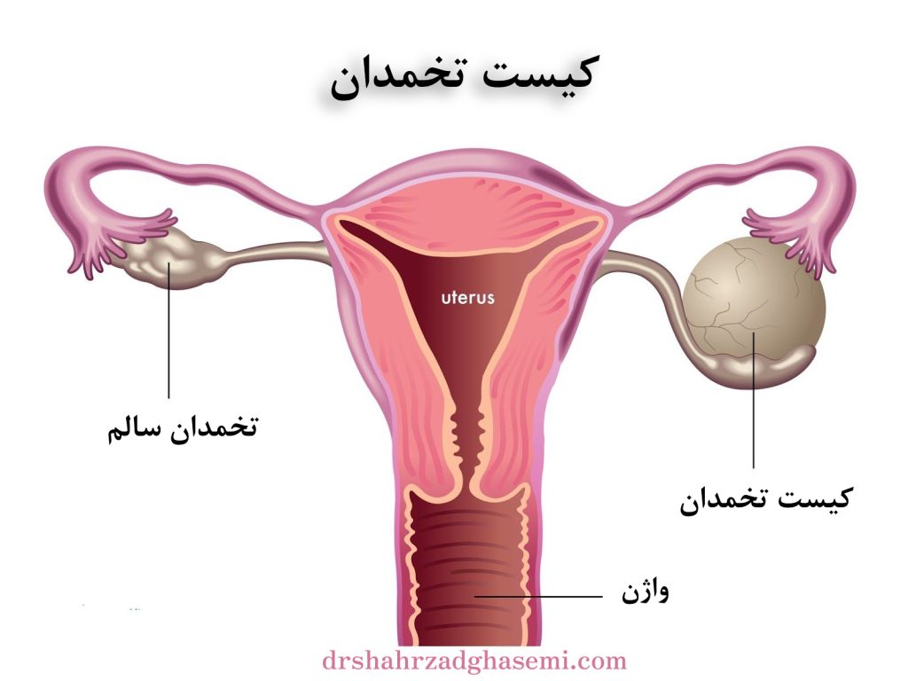 کیست تخمدان انواع مختلفی دارد که معمولا بی خطر هستند.
