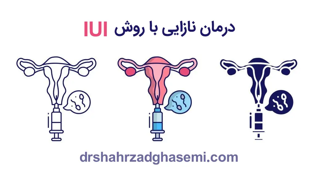 درمان نازایی با روش iui