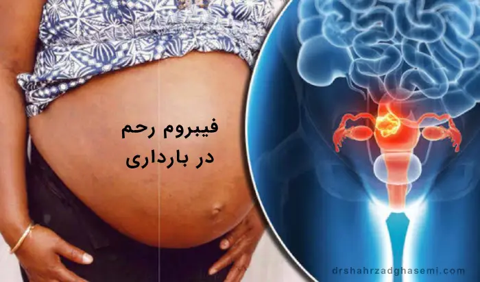 خطر فیبروم رحم در بارداری